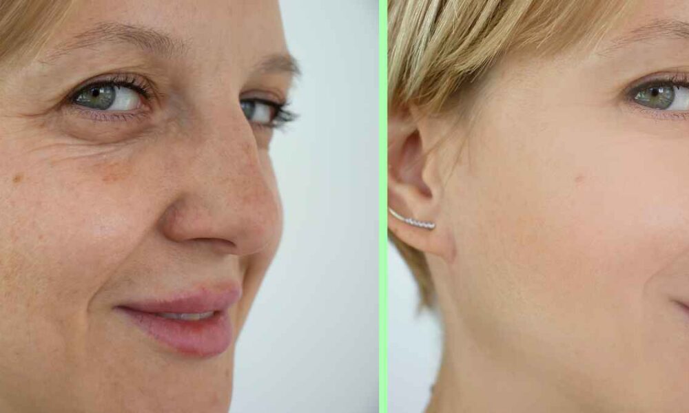 Phenol Peel Before and After